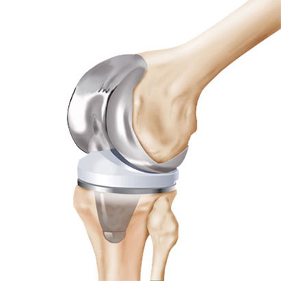 Knee Replacement Candidates